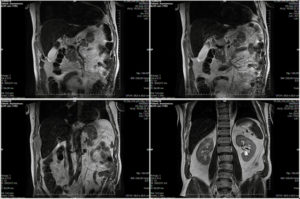 МРТ брюшной полости и забрюшинного пространства: отзывы. МРТ брюшной полости: что входит? Правильная подготовка к МРТ брюшной полости – залог достоверного диагноза Мрт брюшной и забрюшинной полости что показывает