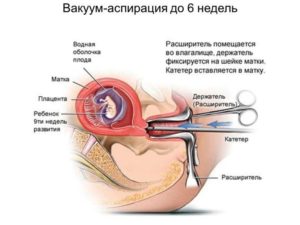 До какого срока делают вакуумный аборт, как он проходит, каковы последствия прерывания беременности? Вакуумное прерывание беременности: сроки и отзывы