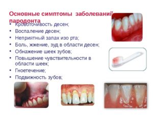 Кровоточивость десен и запах изо рта. Что делать, если кровоточат десна и неприятный запах изо рта даже после чистки зубов: причины и лечение. Почему кровоточат десна