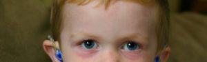 Синяки под глазами у ребенка комаровский. У ребенка под глазами синяки: возможные причины, уход, методы лечения