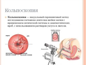 Сколько дней делается анализ после кольпоскопии. До и после кольпоскопии шейки матки: описание метода исследования