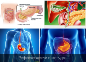 Почему выделяется много желчи. Почему попадает желчь в желудок: симптомы и лечение