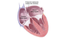 Овальное окно 9 лет может ли закрыться. Если у ребенка обнаружили открытое овальное окно в сердце