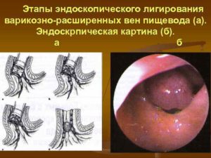 Эндоскопическое лигирование варикозно расширенных вен пищевода. Особенности легирования вен пищевода Лигирование поверхностных сосудов в ране