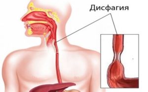Почему трудно глотать пищу. Нарушение глотания