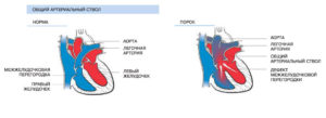 Общий артериальный ствол: описание, заболевания, лечение. Врожденные пороки сердца: общий артериальный ствол