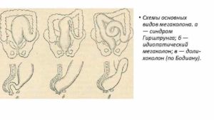 Как проявляется и лечится мегаколон у детей? Мегаколон у детей: что нужно делать? Лечение мегаколона кишечника