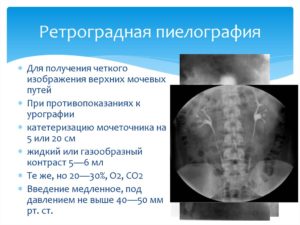 Ретроградная пиелография как проводится. Пиелография (ретроградная, внутривенная, антеградная): что это, подготовка и проведение. Показания к пиелографии