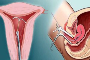 Беременность после спирали совет гинеколога. Можно ли забеременеть после удаления спирали, советы гинеколога