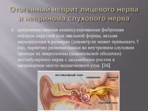 Симптомы невриномы слухового нерва: лечение традиционными и народными средствами. Питание при невриноме