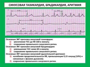 Можно ли умереть от тахикардии. Тахикардия это опасно