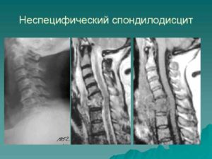 Лечение, симптомы и диагностика дисцита и спондилодисцита