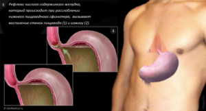 Тяжесть в пищеводе и желудке. Дискомфорт в пищеводе