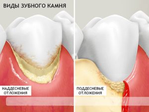 Стоматологическая паста для удаления зубного камня. Способы удаления зубного камня в домашних условиях. Причины образования камней на зубах