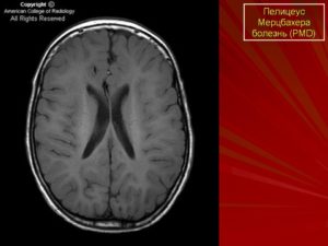 Лейкодистрофия (прогрессирующий склероз мозга). Что за болезнь лейкодистрофия Пелицеуса — Мерцбахера? Лейкодистрофия симптомы