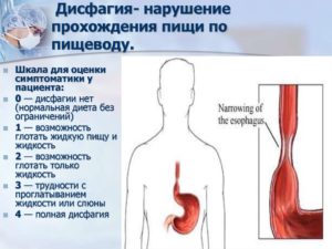 Пища плохо проходит по пищеводу причины. Не проходит пища в желудок