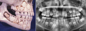 Нет зачатков коренных зубов что делать. Бывают ли у взрослых молочные зубы