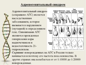 Адреногенитальный синдром у младенца. Адреногенитальный синдром