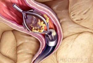 Стент в мочеточнике боли при мочеиспускании. Победить тяжелые заболевания почек возможно! Инкрустация стента и возможная его окклюзия