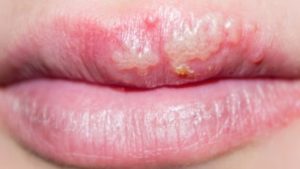Незаживающая язва на губе. Что делать, если в уголке рта или на губе появилась болячка