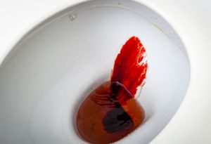 Во время туалета идет кровь. Причины появления крови на туалетной бумаге