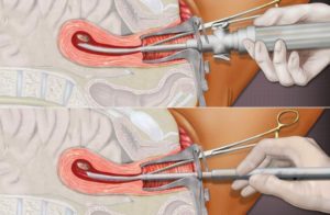 Выскабливание матки после родов. Выскабливание после родов