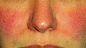 Что делать, если на носу появились красные пятна. Что делать и как избавиться от покраснения носа