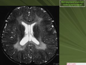 Лейкодистрофия (прогрессирующий склероз мозга). Что за болезнь лейкодистрофия Пелицеуса — Мерцбахера? Лейкодистрофия симптомы