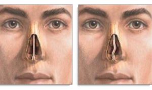 Как исправить носовую перегородку без операции упражнения. Перфорация носовой перегородки: причины, симптомы, методы лечения и последствия