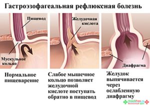 Что такое пролапс желудка. Симптомы и лечение пролапса слизистой желудка в пищевод. Признаки ГЭР, являющегося патологией