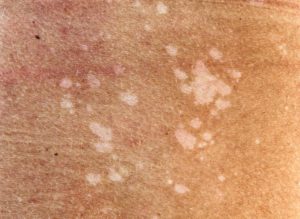Солнечный грибок на коже: причины, симптомы и лечение. Солнечный грибок