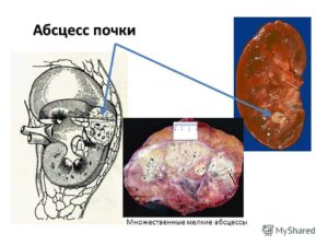 Абсцесс почки лечение. Абсцесс почки что это такое. Причины и факторы развития