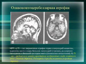 Клиническая картина и лечение атрофии мозжечка. Атрофия мозжечка последствия