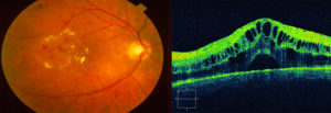 Макулярный отёк сетчатки глаза. Кистозный макулярный отек