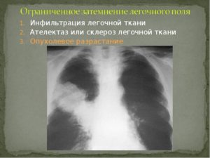 Инфильтрат в легких: что это такое? Что такое инфильтрация лёгочной ткани