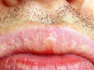 Белые пятна на губах. Что такое подкожные белые точки на губах? Причины и лечение