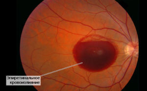 Что такое эпиретинальный фиброз глаз. Народные рецепты для лечение фиброза сетчатки глаза