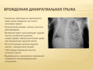 Чем опасна диафрагмальная грыжа у новорожденных. Диафрагмальная грыжа у новорожденных