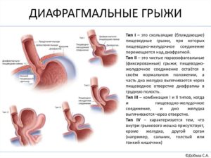 Скользящая диафрагмальная грыжа. Причины появления скользящей кардиальной грыжи и ее лечение. Диета и питание