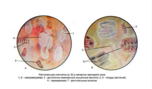 Копрограмма — Общий анализ кала. Креаторея — мышечные волокна в кале: причины и лечение