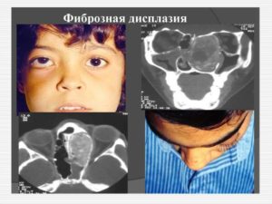 Фиброзно кистозная дисплазия плечевой кости. Фиброзная дисплазия. Фиброзная дисплазия черепа: лечение