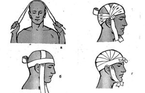 Как сделать повязку на голову из бинта. Наложение повязки на голову: особенности проведения процедуры