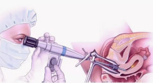 Реабилитация после гистероскопии матки. Что происходит после гистероскопии — сроки и особенности восстановления, возможные проблемы