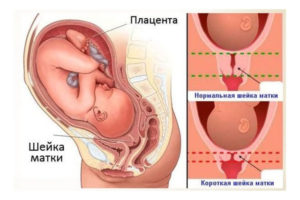 Что если шейка матки короткая. Опасно ли укорочение шейки матки при беременности и почему возникает это состояние