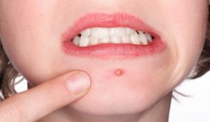 Чирей внутри губы. Как лечить фурункулы на половых губах на разных стадиях болезни