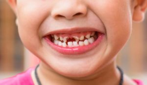 Детская зубная боль. Нужно ли лечить молочные зубы у детей. Лечить или ждать, когда выпадут — нужно ли лечить молочные зубы
