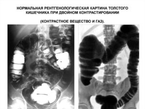 Подготовка к кт жкт. С контрастным веществом. Расшифровка результатов диагностики