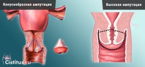 Ножевая ампутация шейки матки. Что собой представляет операция? Виды и порядок проведения операции по ампутации шейки матки