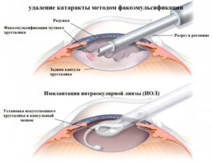 Архив метки: подшивание ИОЛ. Какие осложнения после операции катаракты