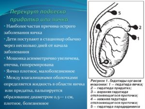 Перекрут гидатиды яичка: что это такое, диагностика заболевания, лечение. Причины возникновения и лечение гидатиды яичника